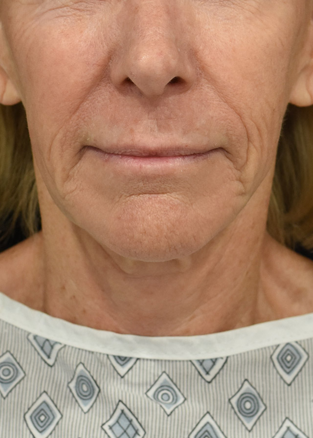 Deep Plane Facelift Patient 31 Set 1 Before
