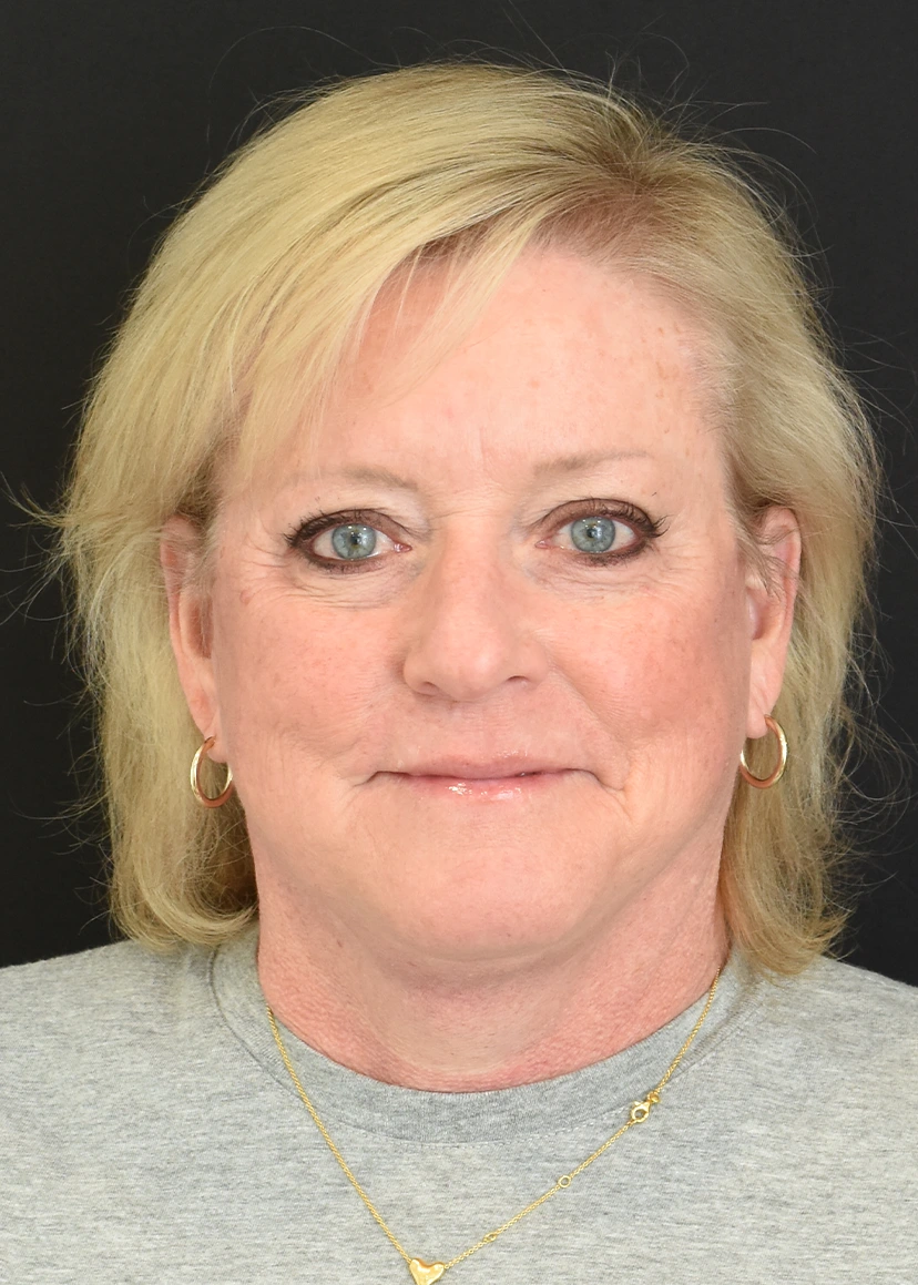 Deep Plane Facelift Patient 39 Set 1 After